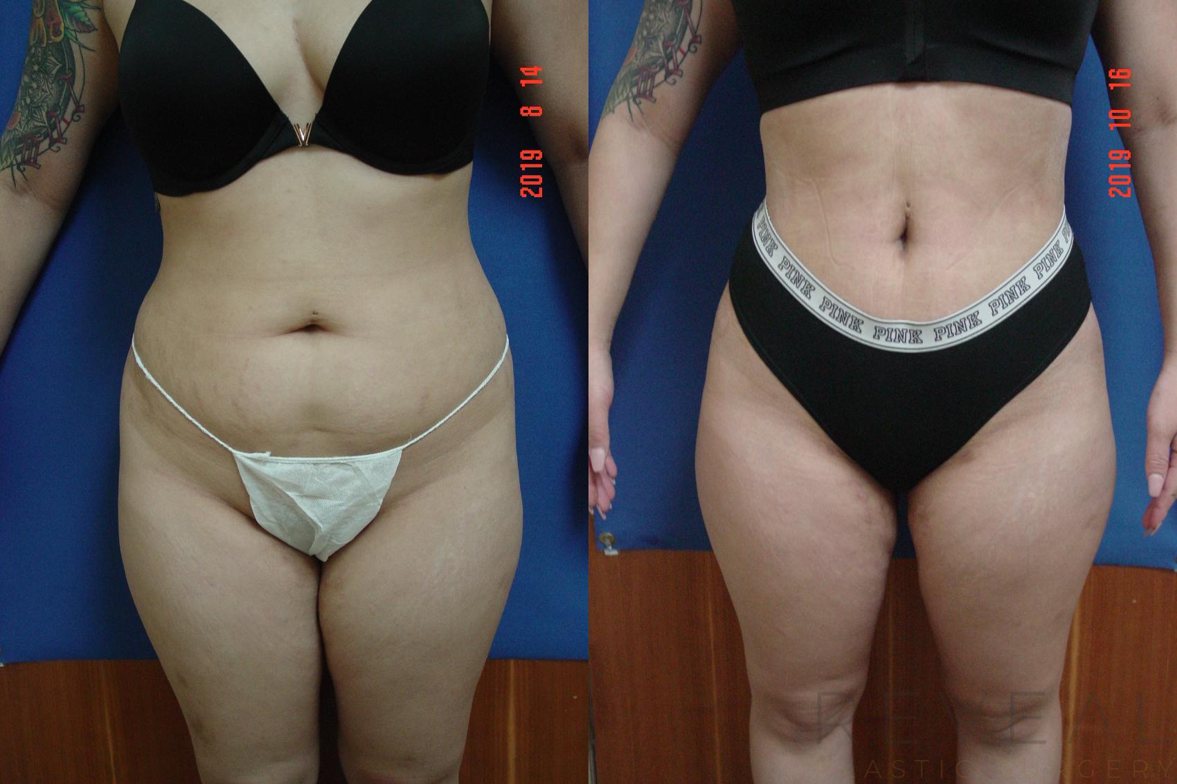 Before & After Brazilian Butt Lift Case 370 View #1 View in San Jose, CA