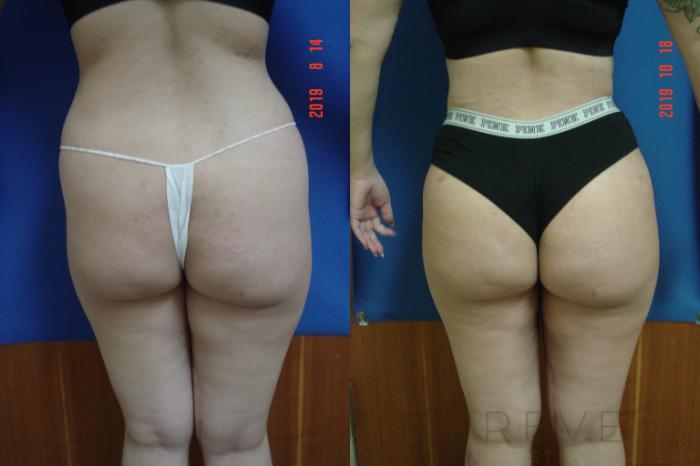 Before & After Brazilian Butt Lift Case 370 View #2 View in San Jose, CA