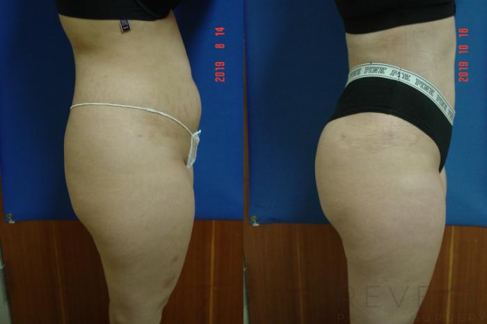 Before & After Brazilian Butt Lift Case 370 View #4 View in San Jose, CA