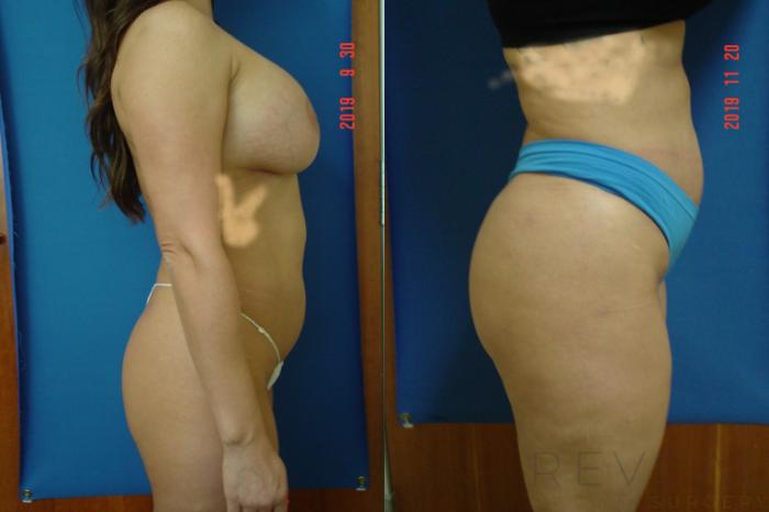 Before & After Brazilian Butt Lift Case 375 View #2 View in San Jose, CA