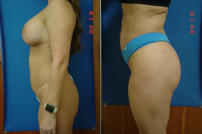 Before & After Brazilian Butt Lift Case 375 View #3 View in San Jose, CA