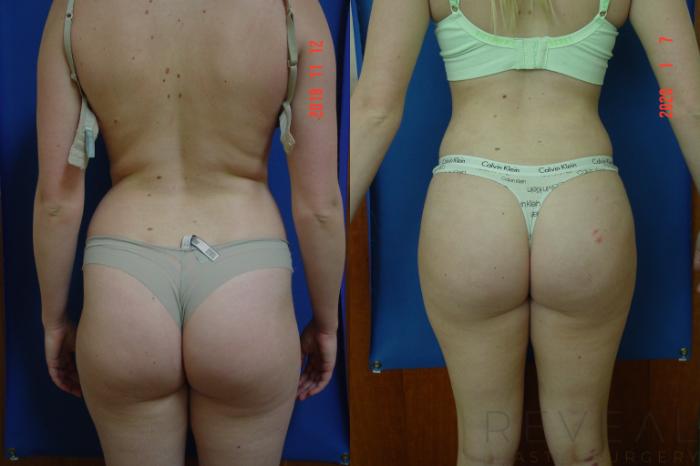Before & After Brazilian Butt Lift Case 383 View #1 View in San Jose, CA