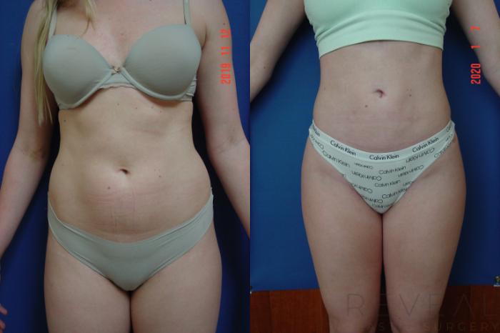 Before & After Brazilian Butt Lift Case 383 View #2 View in San Jose, CA