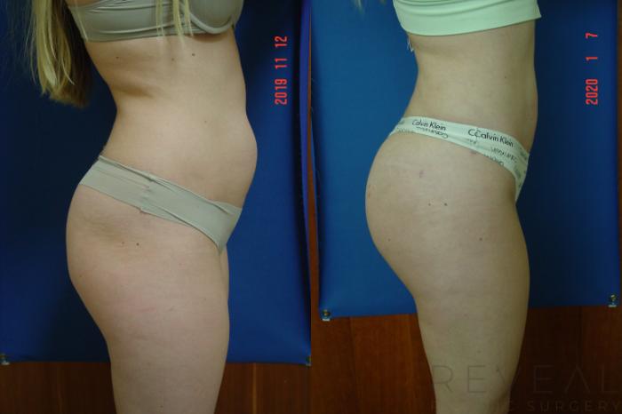 Before & After Liposuction Case 383 View #3 View in San Jose, CA