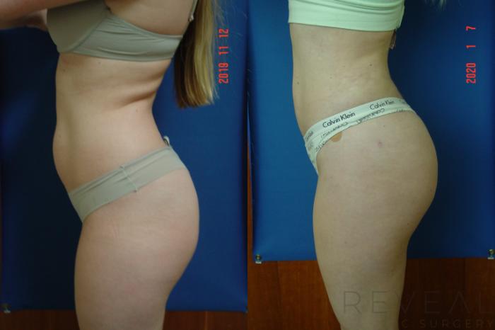 Before & After Brazilian Butt Lift Case 383 View #4 View in San Jose, CA