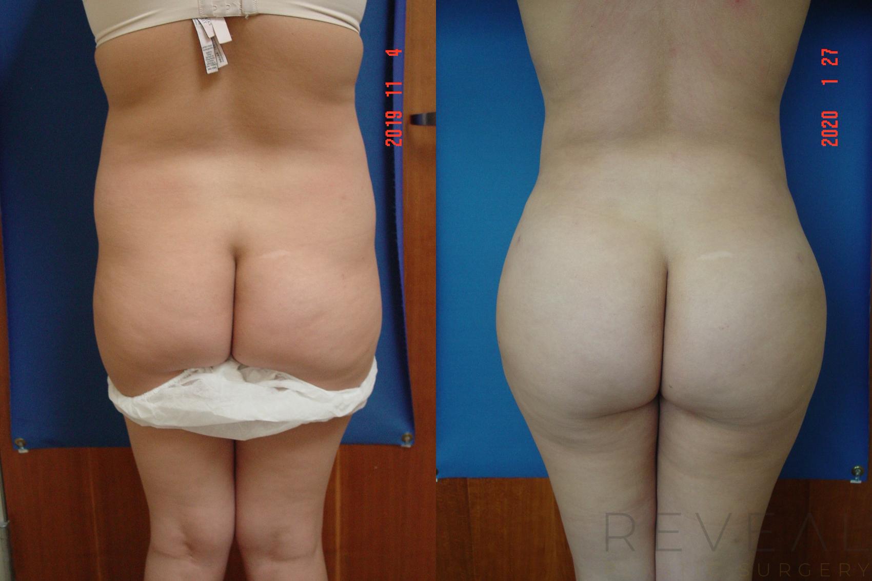 Before & After Liposuction Case 389 View #1 View in San Jose, CA