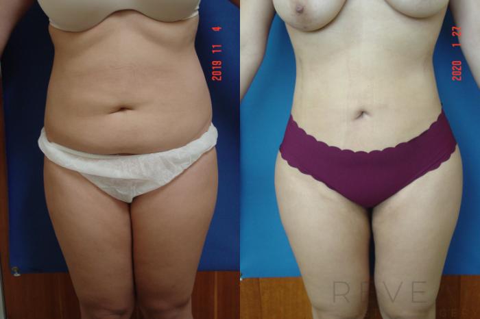 Before & After Liposuction Case 389 View #2 View in San Jose, CA