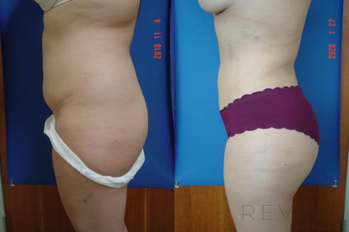 Before & After Liposuction Case 389 View #3 View in San Jose, CA