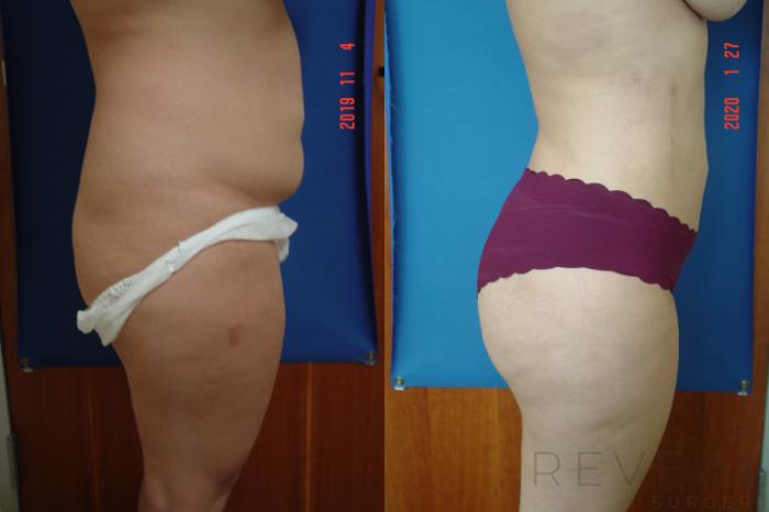 Before & After Liposuction Case 389 View #4 View in San Jose, CA