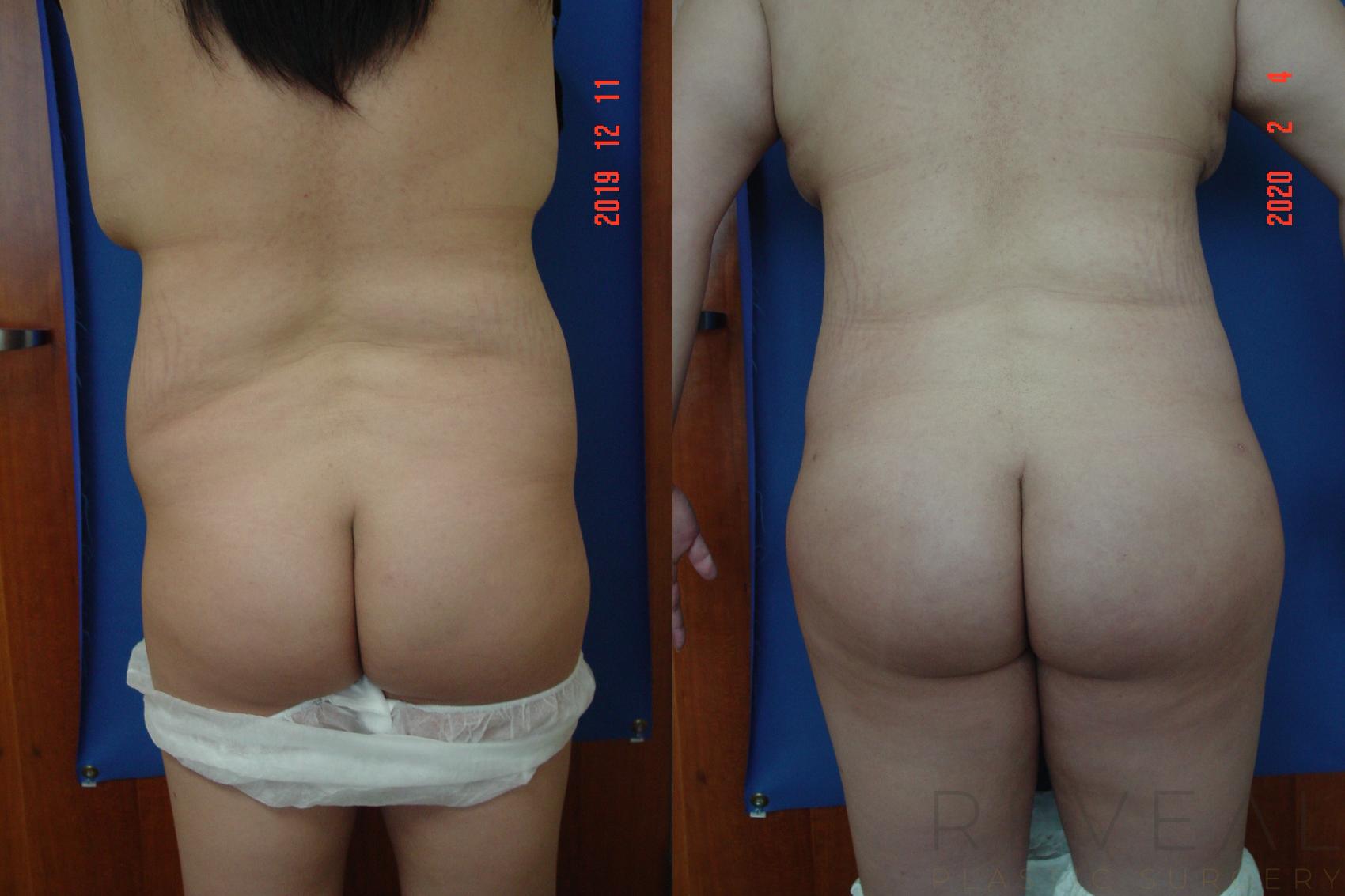Before & After Brazilian Butt Lift Case 391 View #1 View in San Jose, CA