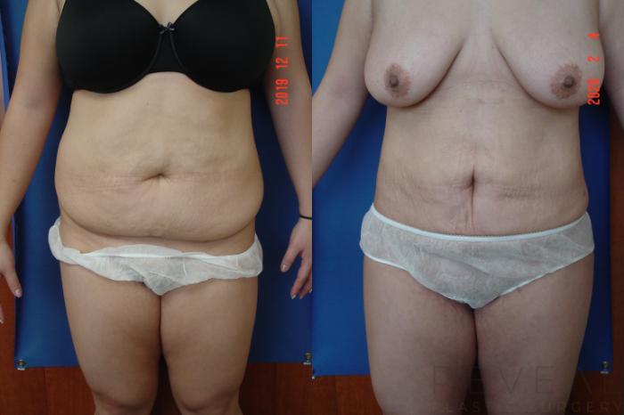 Before & After Brazilian Butt Lift Case 391 View #2 View in San Jose, CA