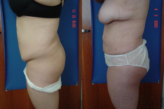 Before & After Brazilian Butt Lift Case 391 View #3 View in San Jose, CA