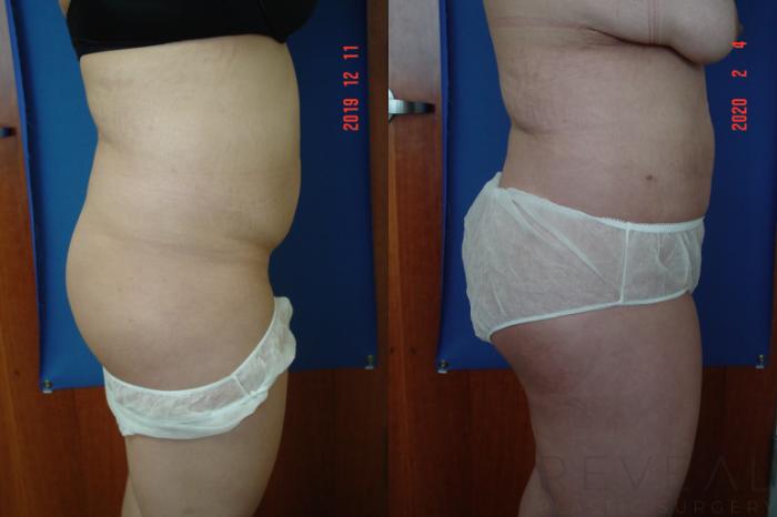 Before & After Brazilian Butt Lift Case 391 View #4 View in San Jose, CA