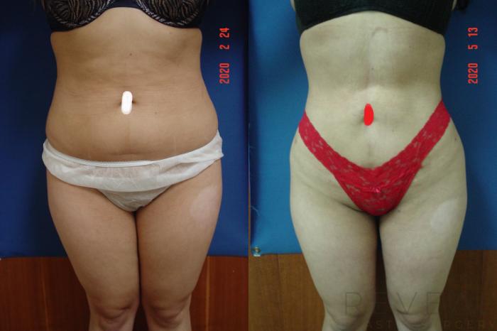 Before & After Brazilian Butt Lift Case 398 View #1 View in San Jose, CA