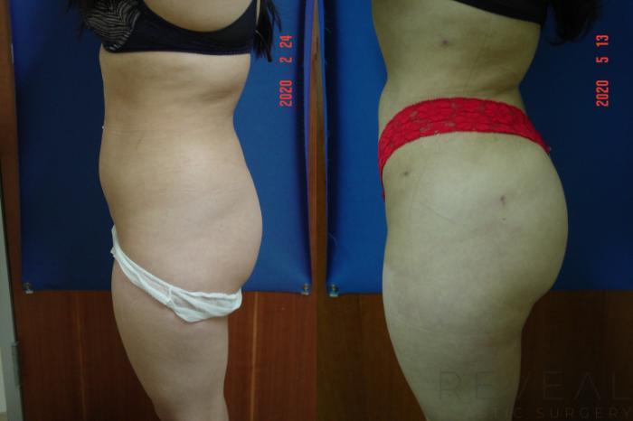 Before & After Brazilian Butt Lift Case 398 View #2 View in San Jose, CA