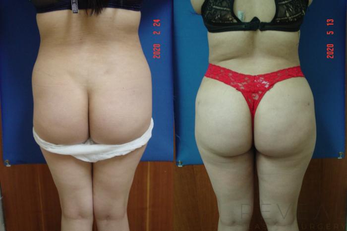 Before & After Brazilian Butt Lift Case 398 View #4 View in San Jose, CA
