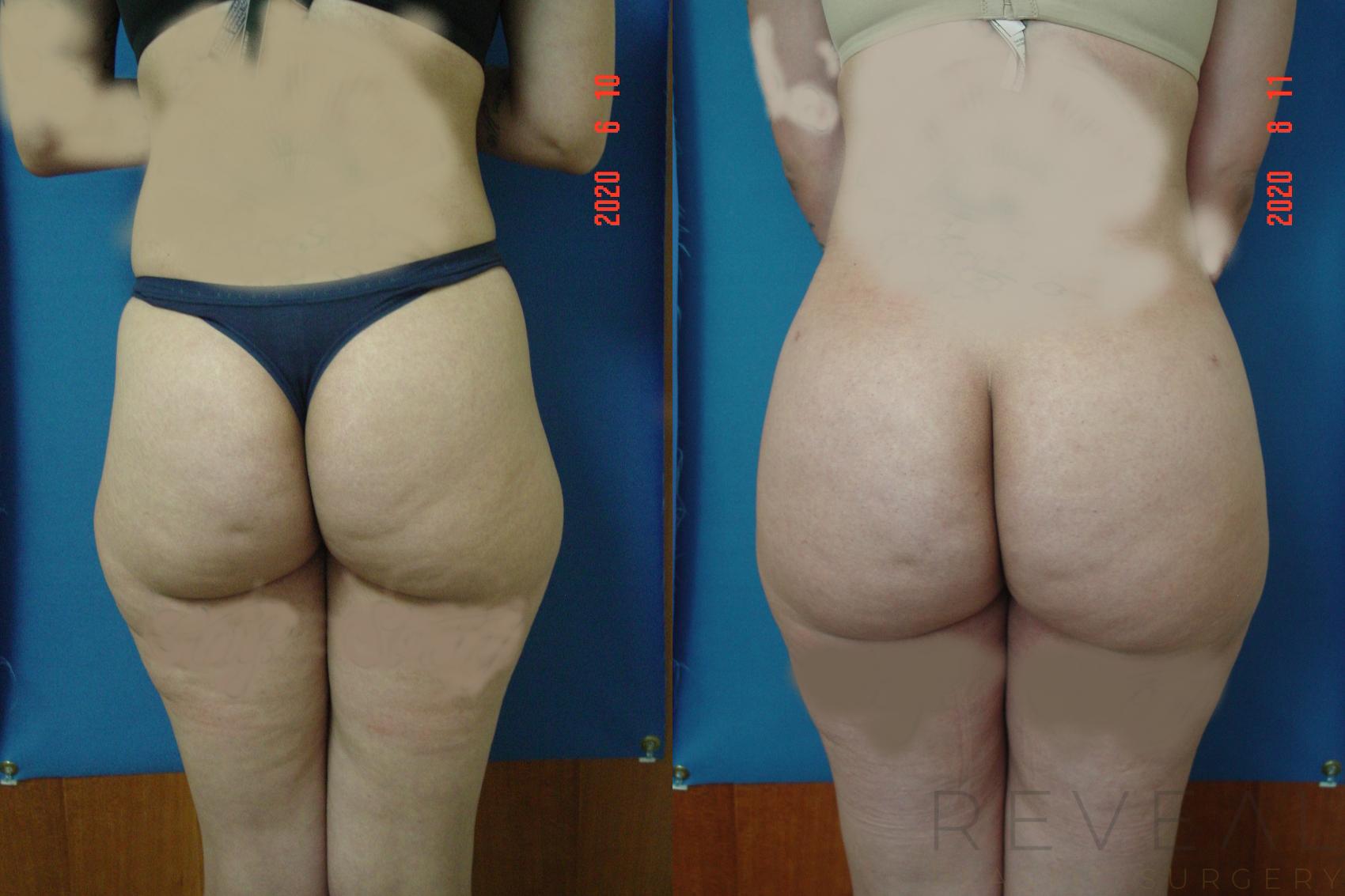 Before & After Brazilian Butt Lift Case 414 View #1 View in San Jose, CA