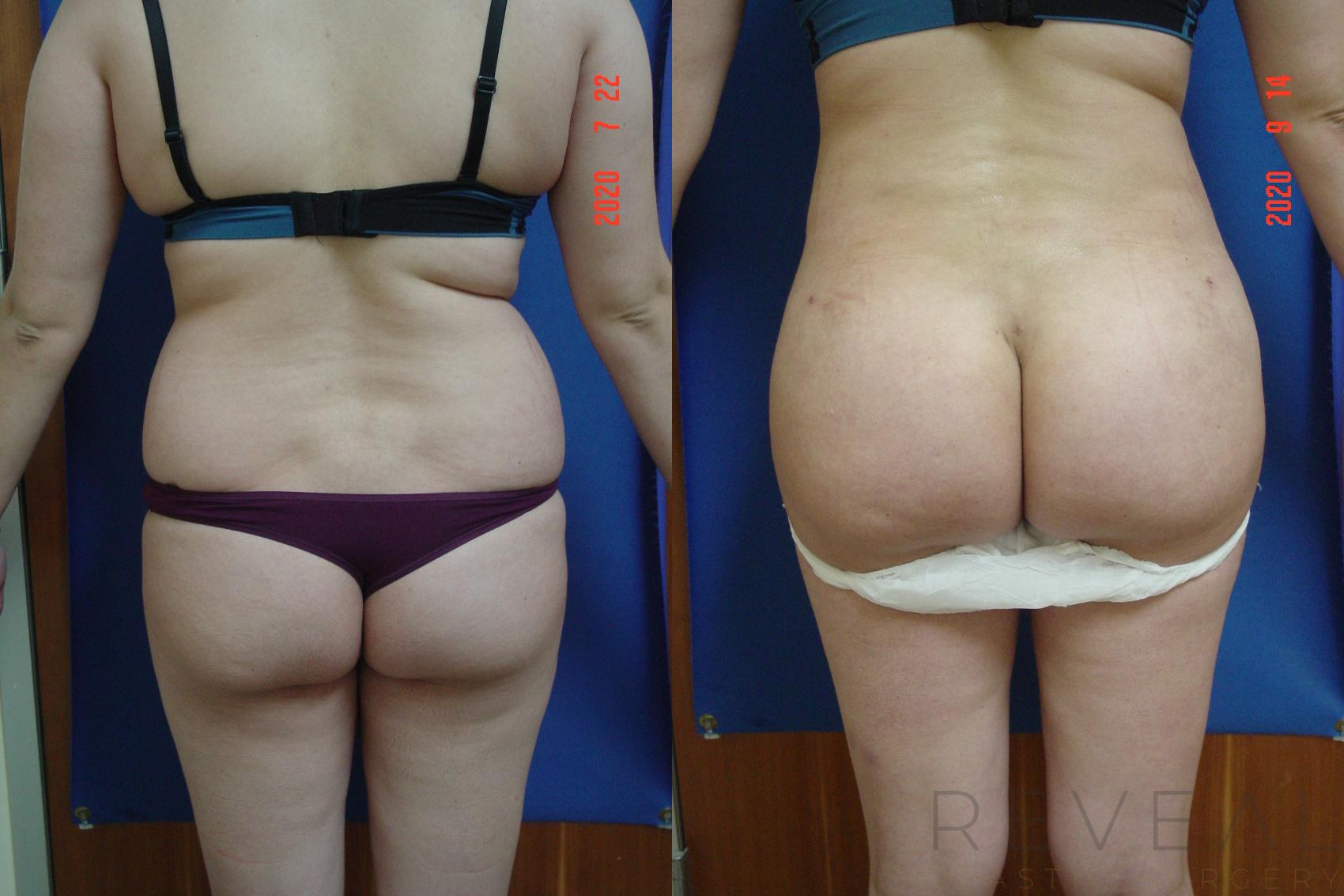Before & After Brazilian Butt Lift Case 421 View #1 View in San Jose, CA