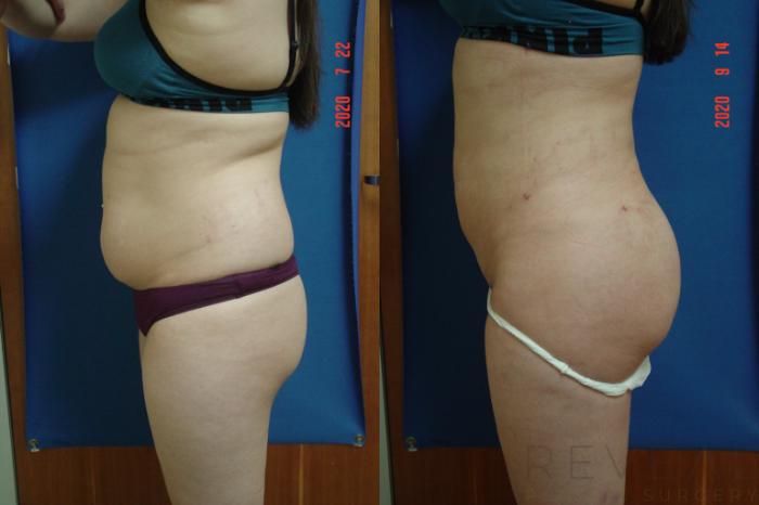 Before & After Brazilian Butt Lift Case 421 View #3 View in San Jose, CA