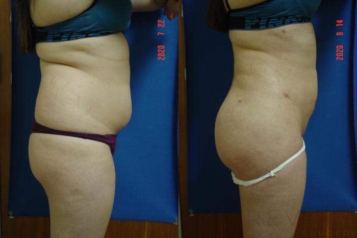 Before & After Brazilian Butt Lift Case 421 View #4 View in San Jose, CA
