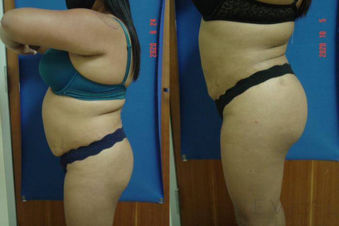 Before & After Brazilian Butt Lift Case 437 View #1 View in San Jose, CA