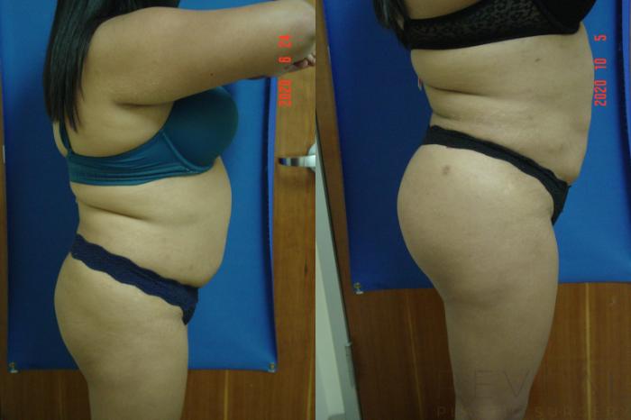 Before & After Brazilian Butt Lift Case 437 View #2 View in San Jose, CA