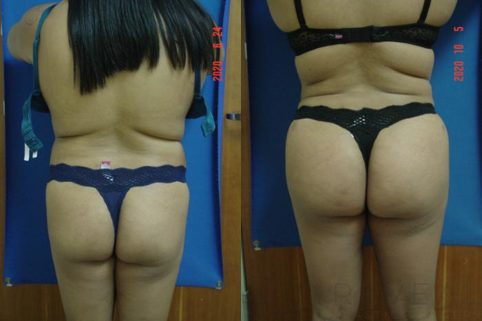 Before & After Liposuction Case 437 View #3 View in San Jose, CA