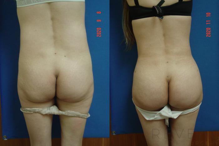 Before & After Brazilian Butt Lift Case 451 View #1 View in San Jose, CA