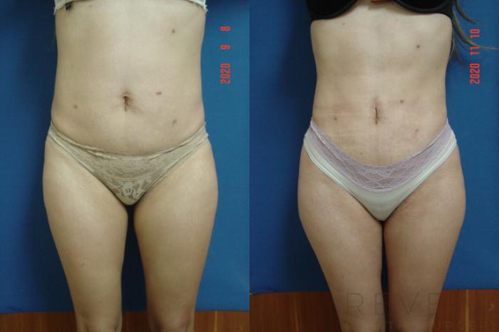 Before & After Brazilian Butt Lift Case 451 View #2 View in San Jose, CA
