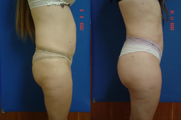 Before & After Brazilian Butt Lift Case 451 View #3 View in San Jose, CA