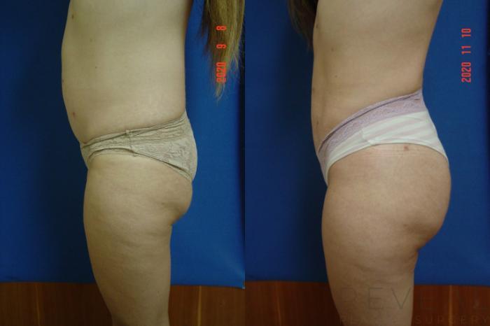 Before & After Brazilian Butt Lift Case 451 View #4 View in San Jose, CA