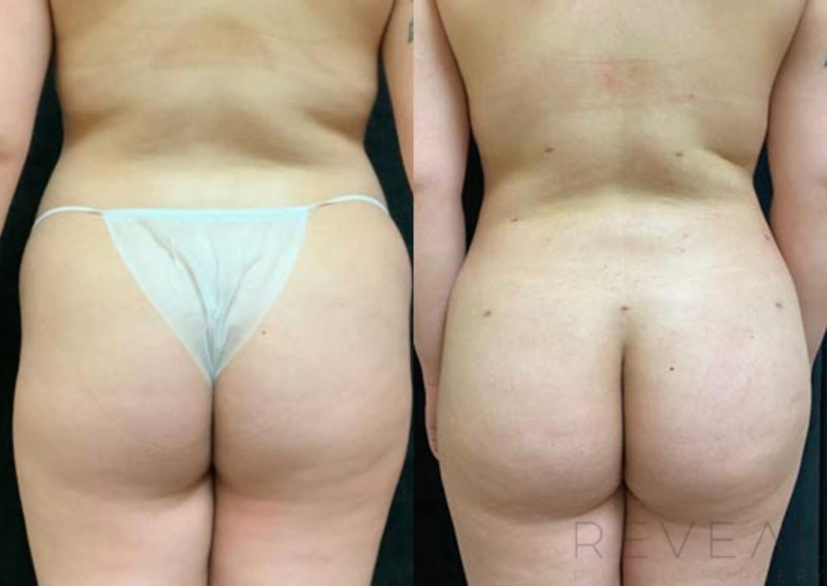 Before & After Brazilian Butt Lift Case 459 View #1 View in San Jose, CA