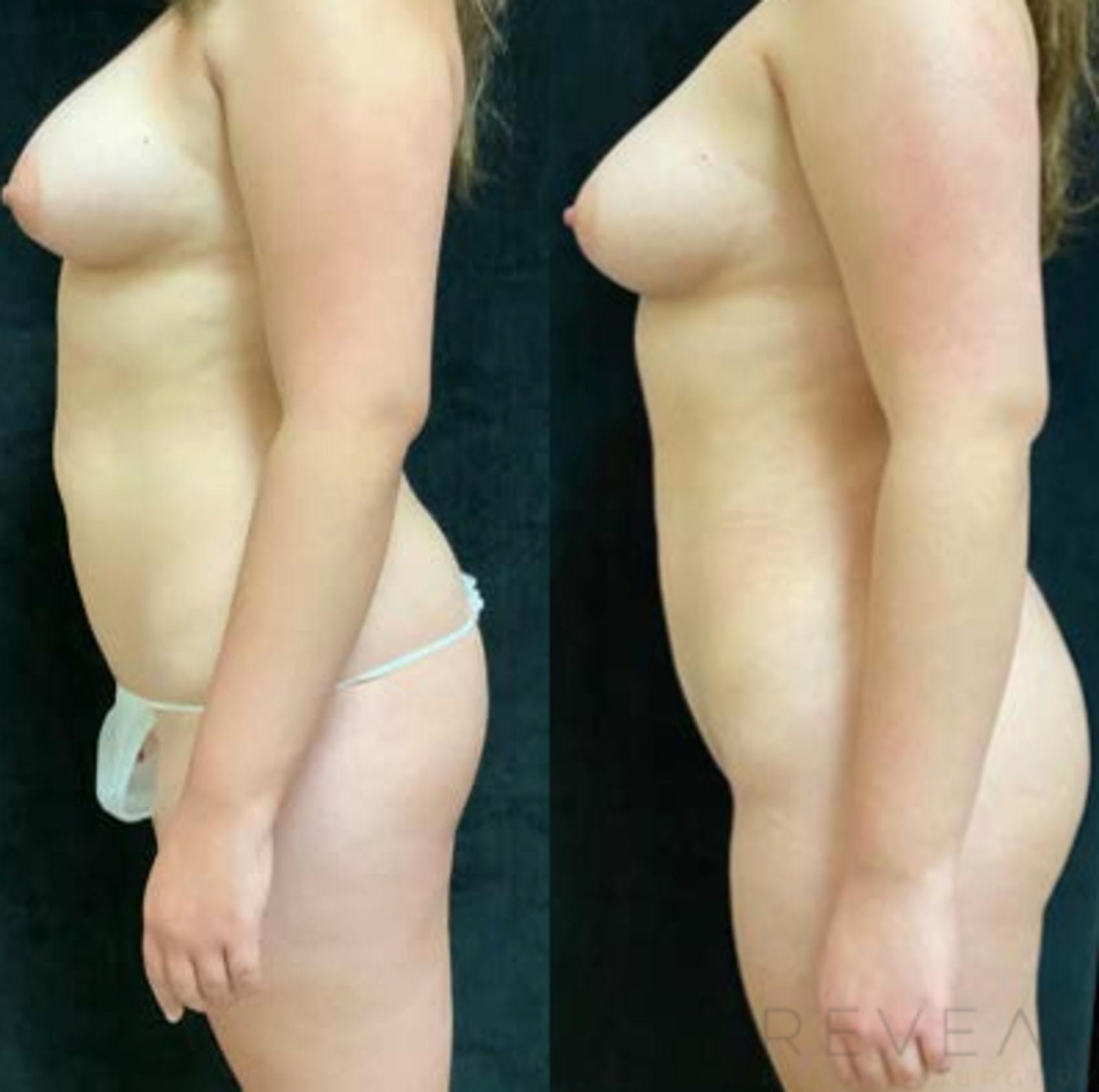 Before & After Brazilian Butt Lift Case 459 View #2 View in San Jose, CA