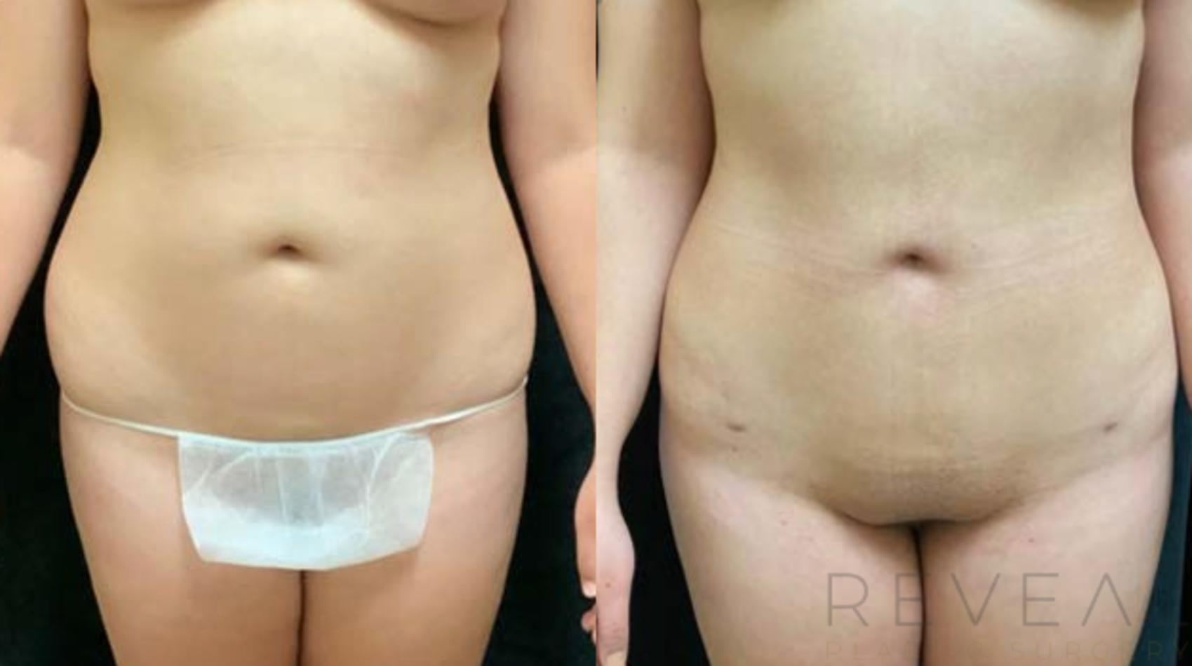 Before & After Brazilian Butt Lift Case 459 View #3 View in San Jose, CA