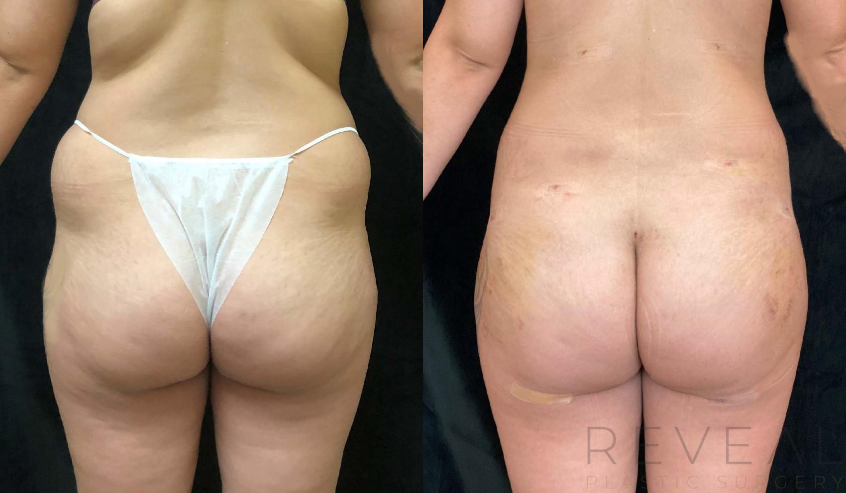 Before & After Brazilian Butt Lift Case 468 View #1 View in San Jose, CA