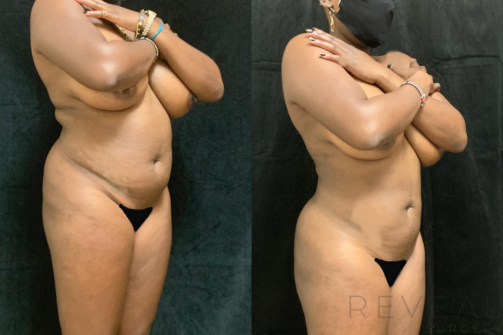 Before & After Liposuction Case 515 View #1 View in San Jose, CA