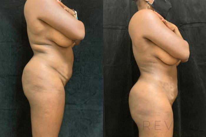Before & After Liposuction Case 515 View #2 View in San Jose, CA