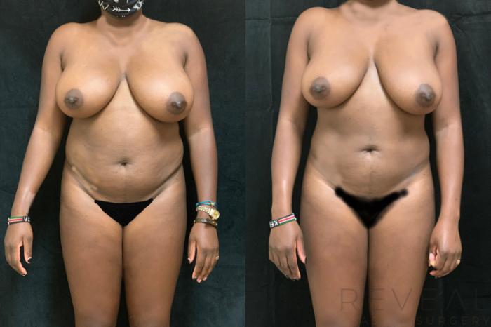 Before & After Liposuction Case 515 View #3 View in San Jose, CA