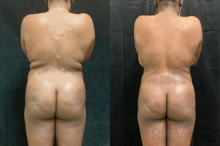 Before & After Brazilian Butt Lift Case 515 View #4 View in San Jose, CA