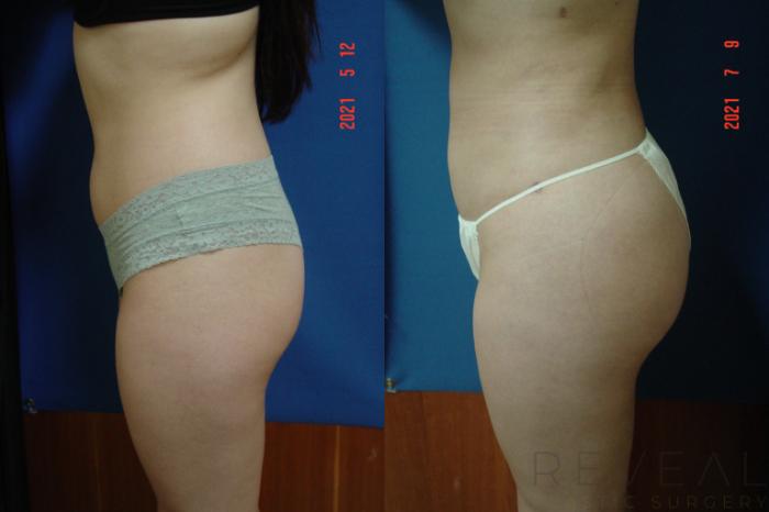 Before & After Brazilian Butt Lift Case 582 View #2 View in San Jose, CA