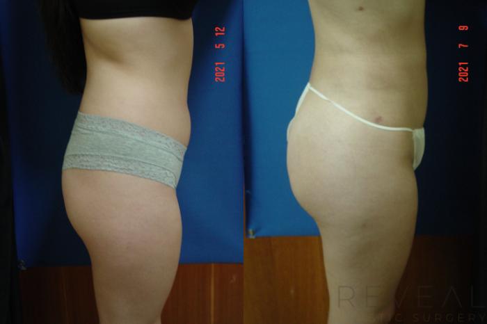Before & After Brazilian Butt Lift Case 582 View #4 View in San Jose, CA