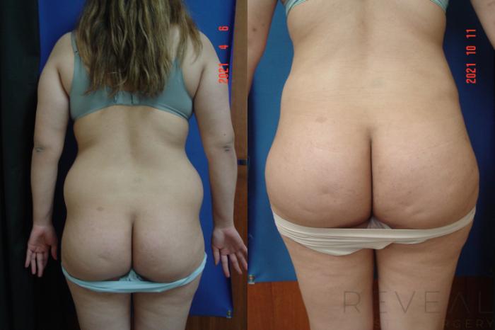 Before & After Brazilian Butt Lift Case 584 View #1 View in San Jose, CA