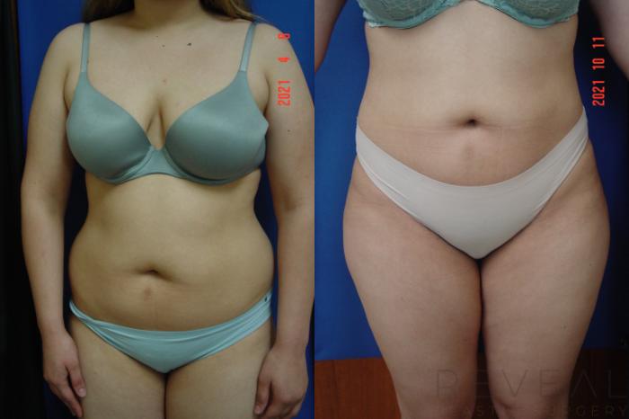 Before & After Brazilian Butt Lift Case 584 View #2 View in San Jose, CA