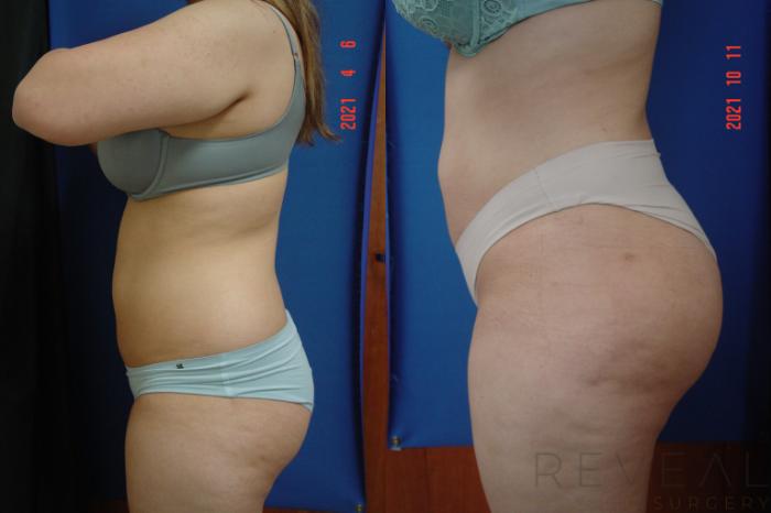Before & After Brazilian Butt Lift Case 584 View #4 View in San Jose, CA