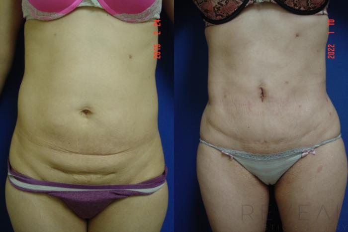 Before & After Liposuction Case 599 Front View in San Jose, CA