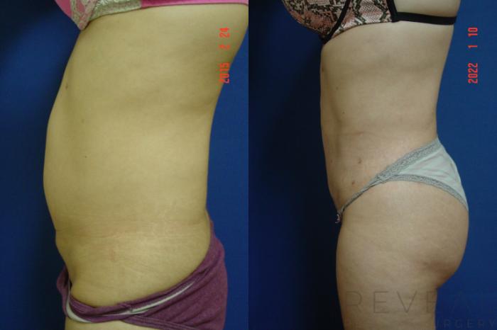 Before & After Liposuction Case 599 Left Side View in San Jose, CA