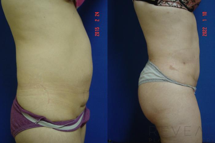 Before & After Liposuction Case 599 Right Side View in San Jose, CA