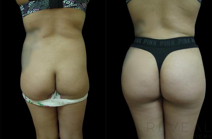 Before & After Liposuction Case 630 Back View in San Jose, CA