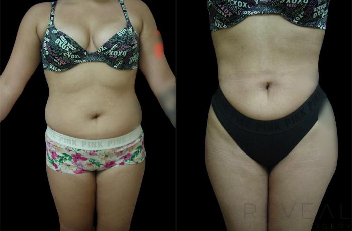 Before & After Brazilian Butt Lift Case 630 Front View in San Jose, CA