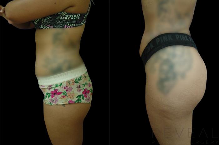 Before & After Brazilian Butt Lift Case 630 Left Side View in San Jose, CA